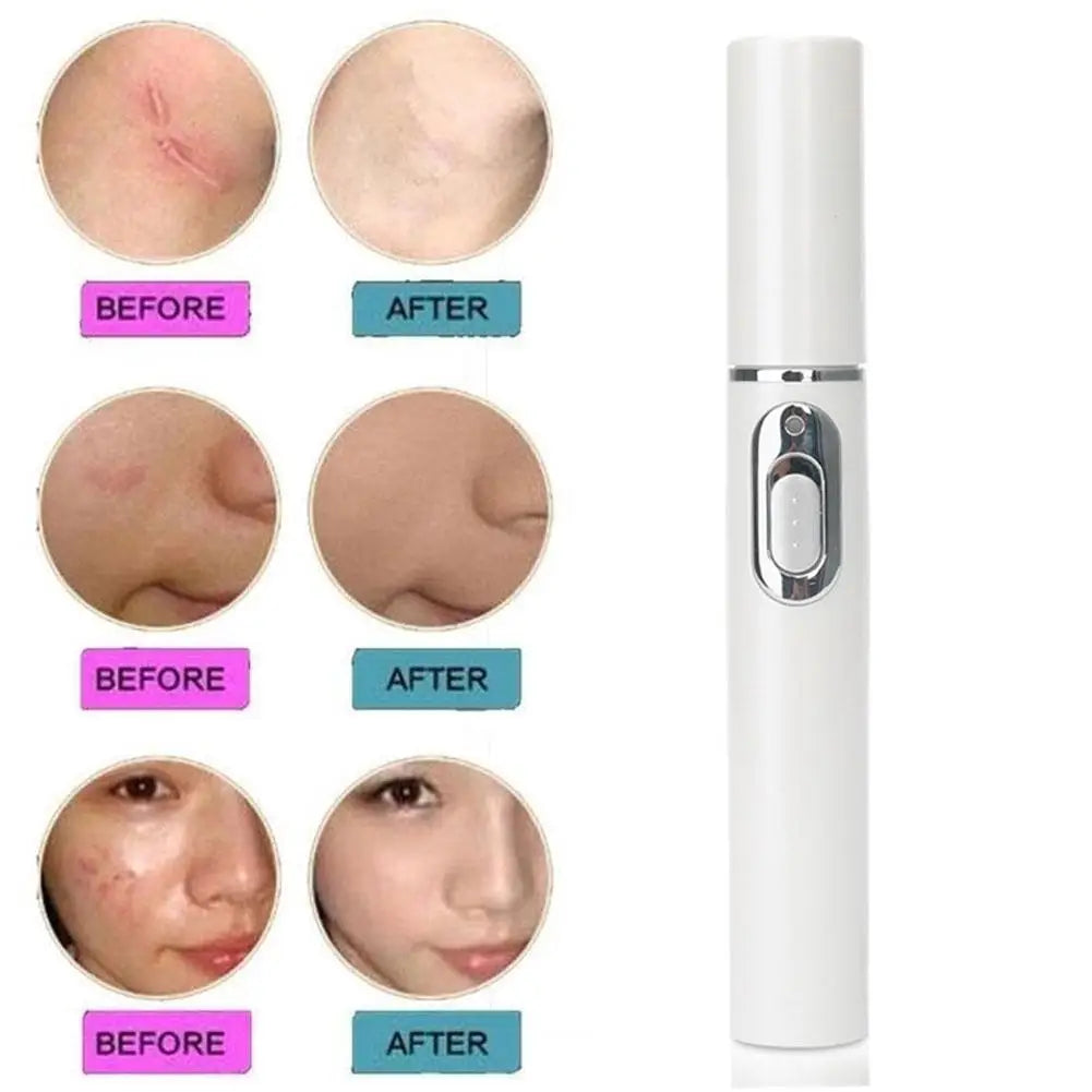 Blue Light Therapy Acne Laser Pen LED Face Light Therapy For Scar Wrinkle Removal Treatment Device Skin Care Beauty Equipment