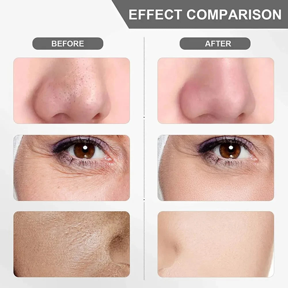Skin Scrubber Remove Vibrate Deep Face Cleaning Dirt Blackhead Reduce Wrinkles Facial Lifting Peeling Tool Not Ultrasonic Shovel