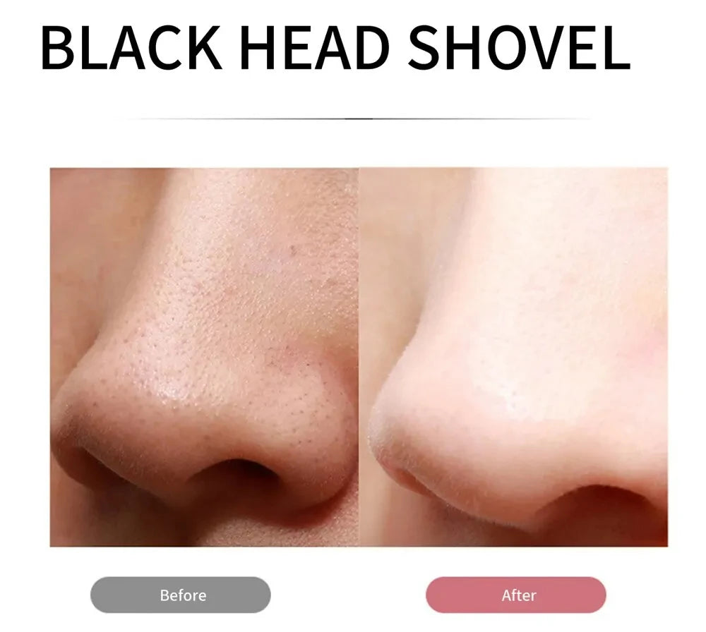 Skin Scrubber Remove Vibrate Deep Face Cleaning Dirt Blackhead Reduce Wrinkles Facial Lifting Peeling Tool Not Ultrasonic Shovel